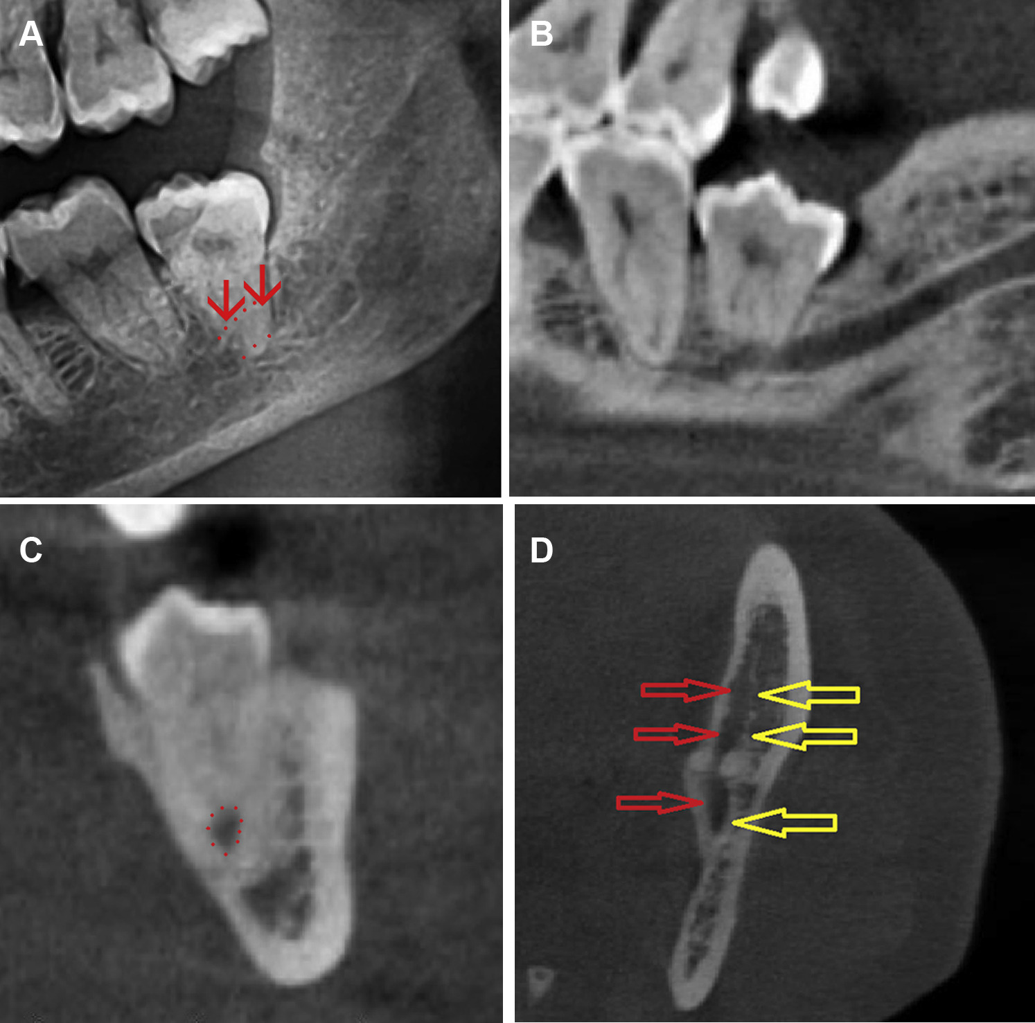 3D CT 진단