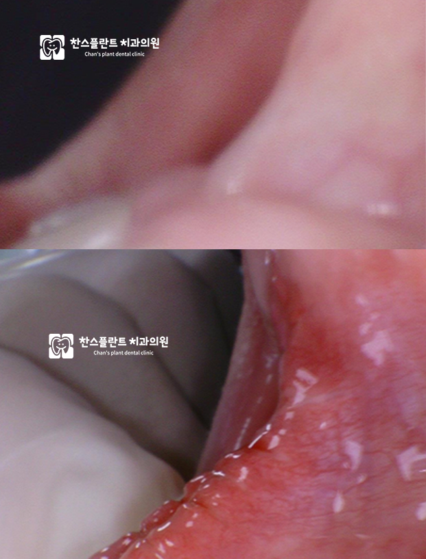 구미동 치과 상순소대 구조 설명
