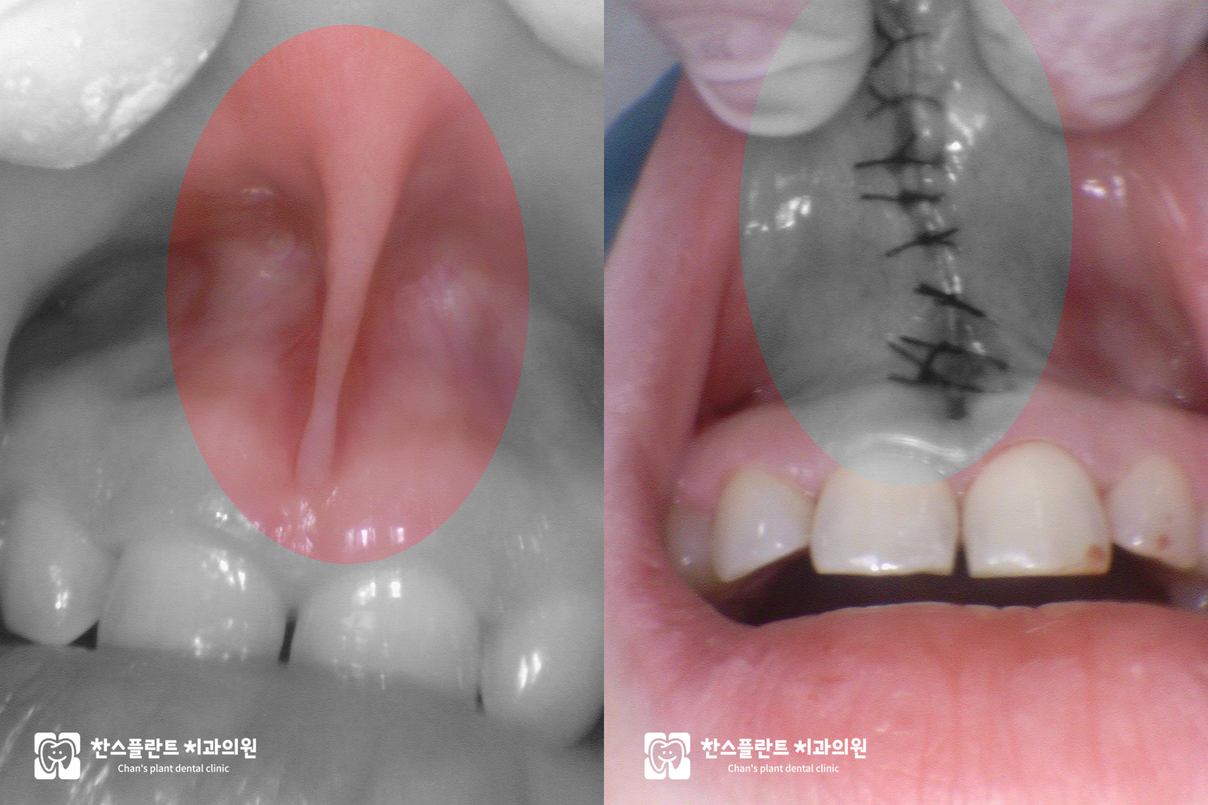 구미동 치과 상순소대절제술 전,후 과정