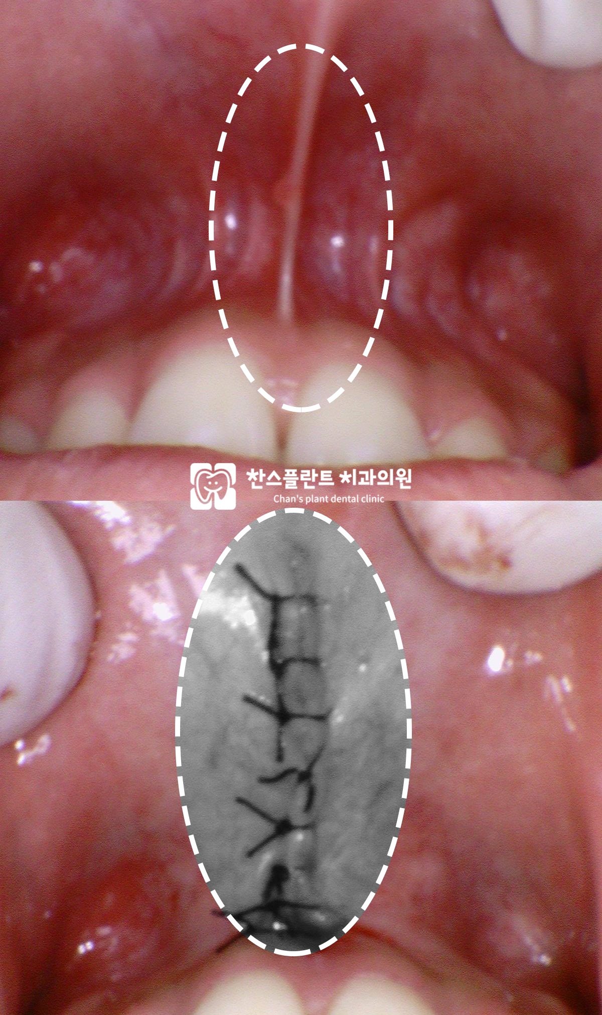구미동 치과 상순소대절제술 수술 장면