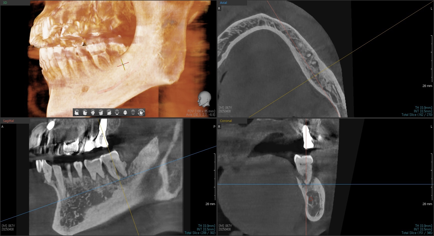 3D CT 정밀 진단