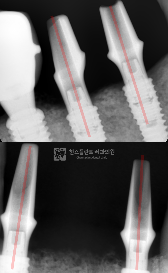 미금역 치과 구강악안면외과 전문의 어버트먼트 각도 조정 설계