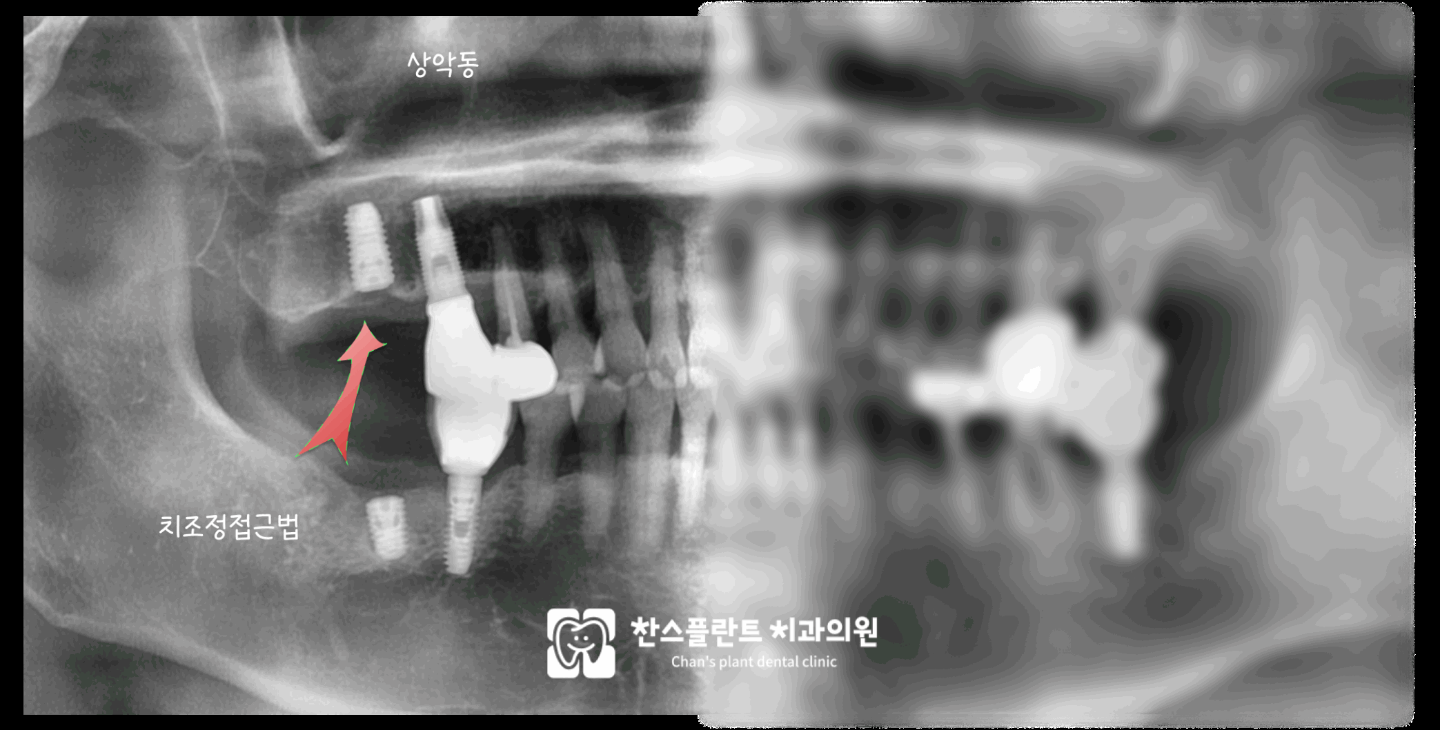 성남 미금역치과 상악동거상술 치조정접근법