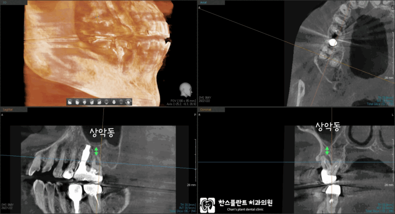 미금역치과상악동수술