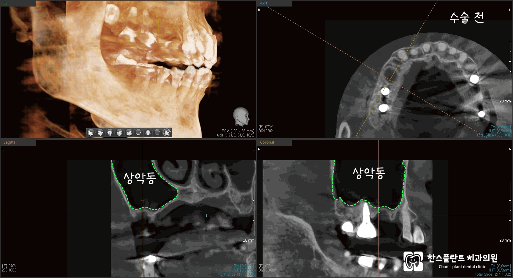 성남 미금역치과 상악동 뼈 부족으로 수술