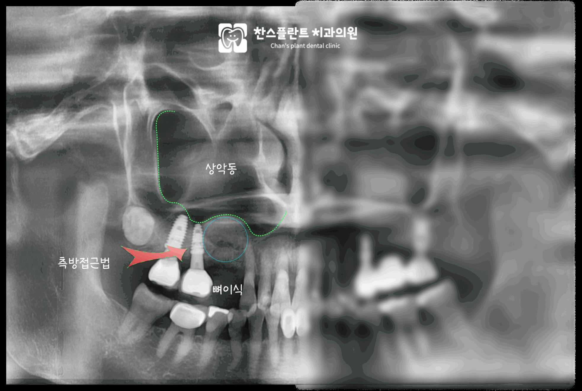 성남 미금역치과 상악동거상술 측방접근법