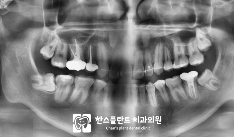 매복사랑니발치