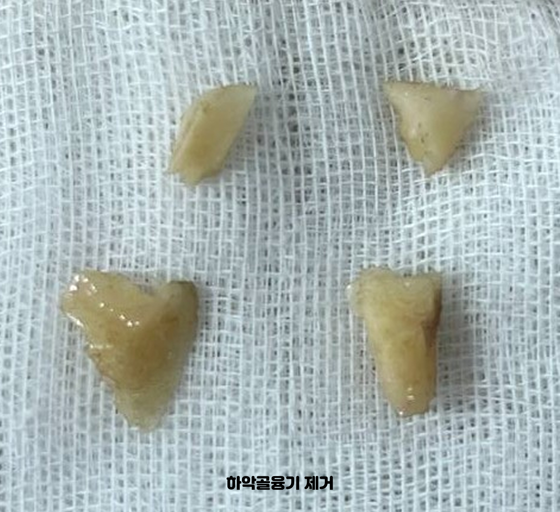 성남 동천역 치과 하악골융기 제거술로 얻은 자가골 조각과 임플란트 뼈이식재 활용