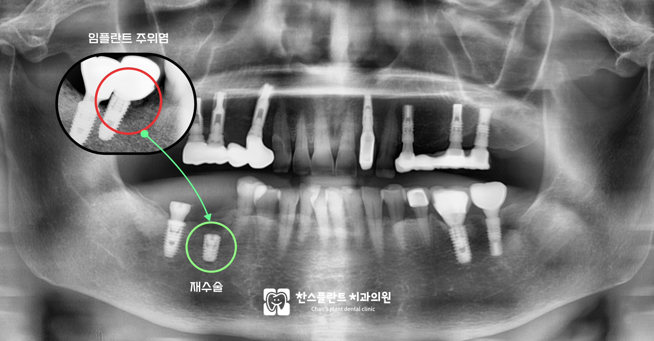 성남 구미동치과 임플란트 주위염 예방을 위한 정기 검진과 위생관리