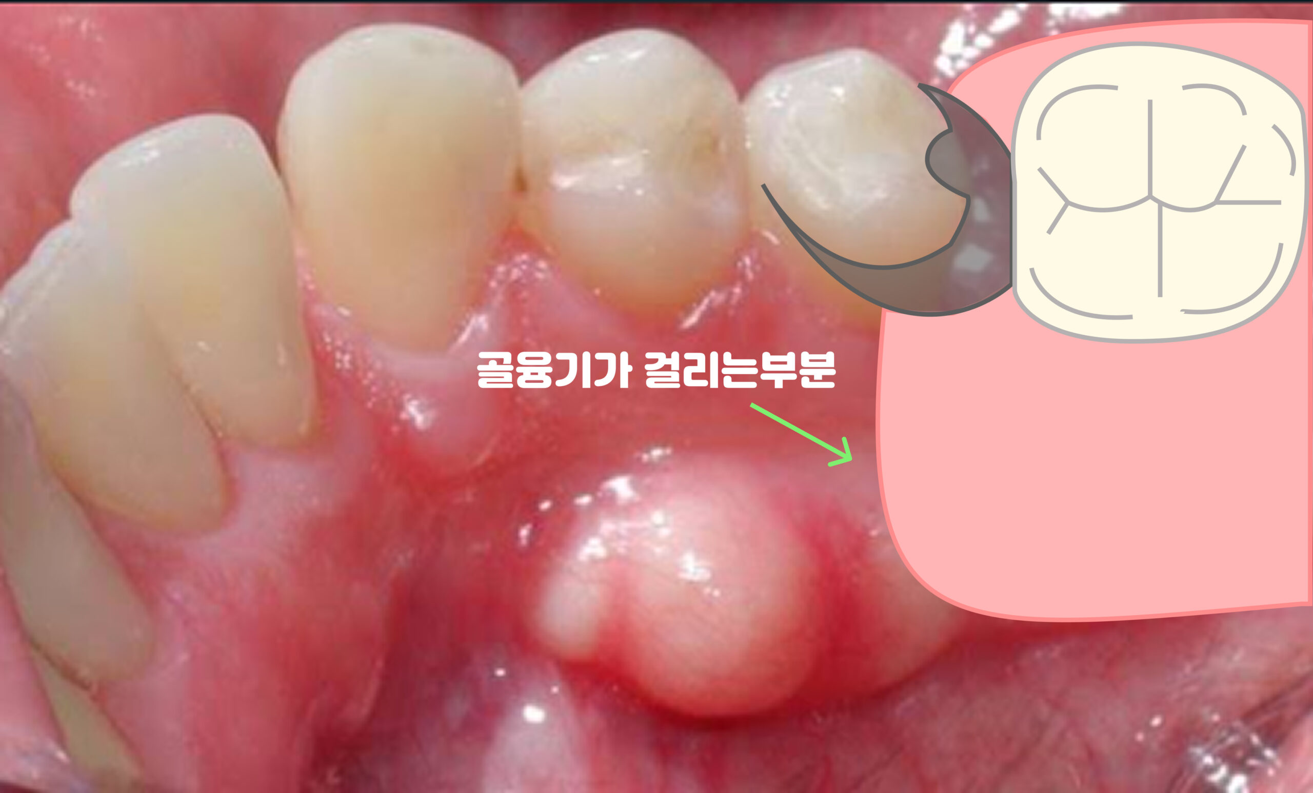 성남 동천역 치과 하악골융기가 틀니에 걸리는 부분