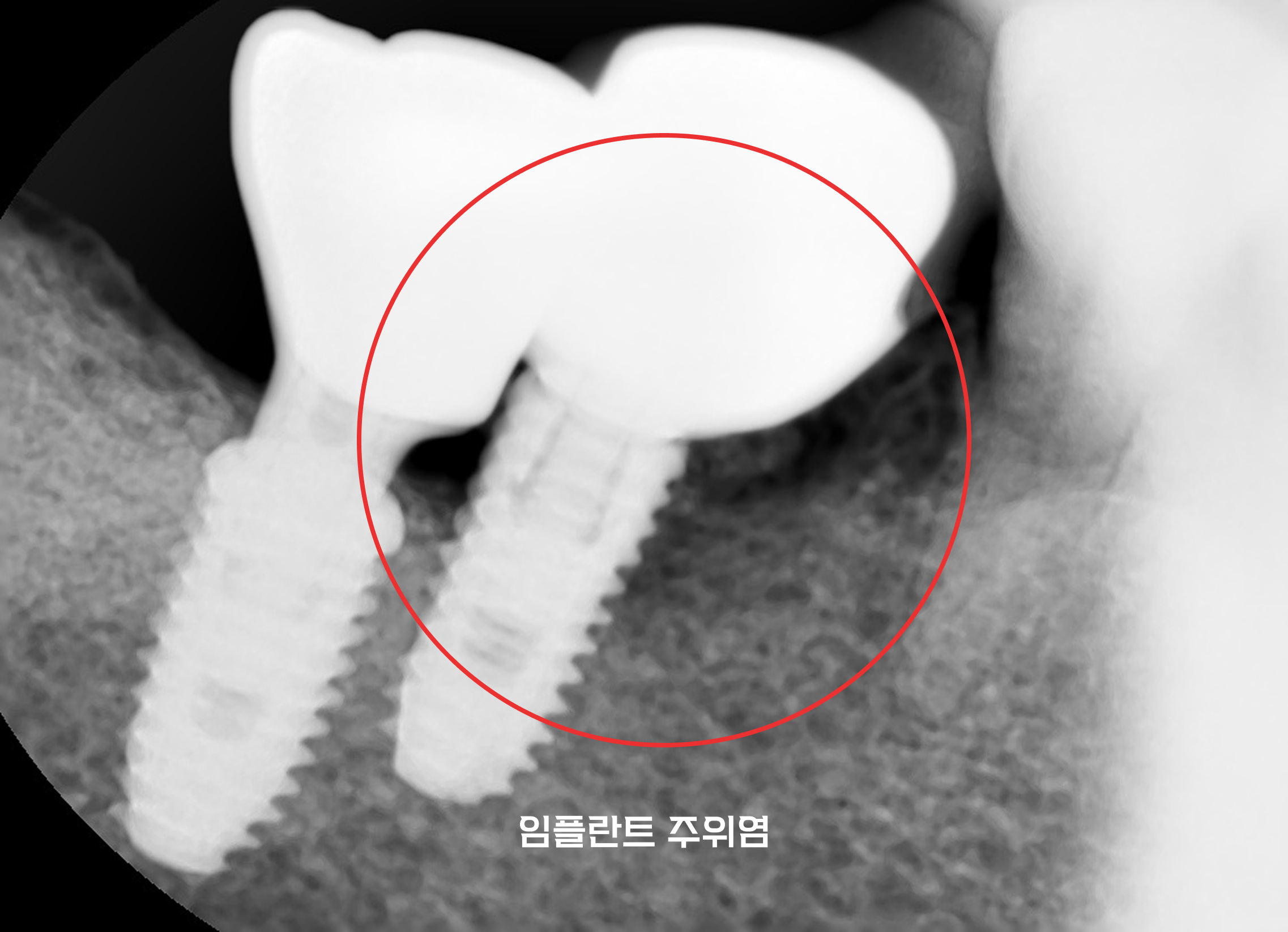 찬스플란트치과의원 로고