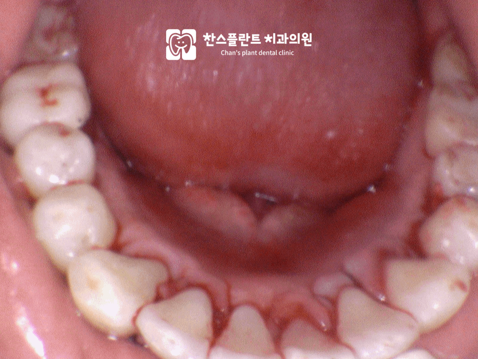성남 동천역 치과 하악골융기 수술 후 매끄러워진 치조제와 틀니 장착 환경