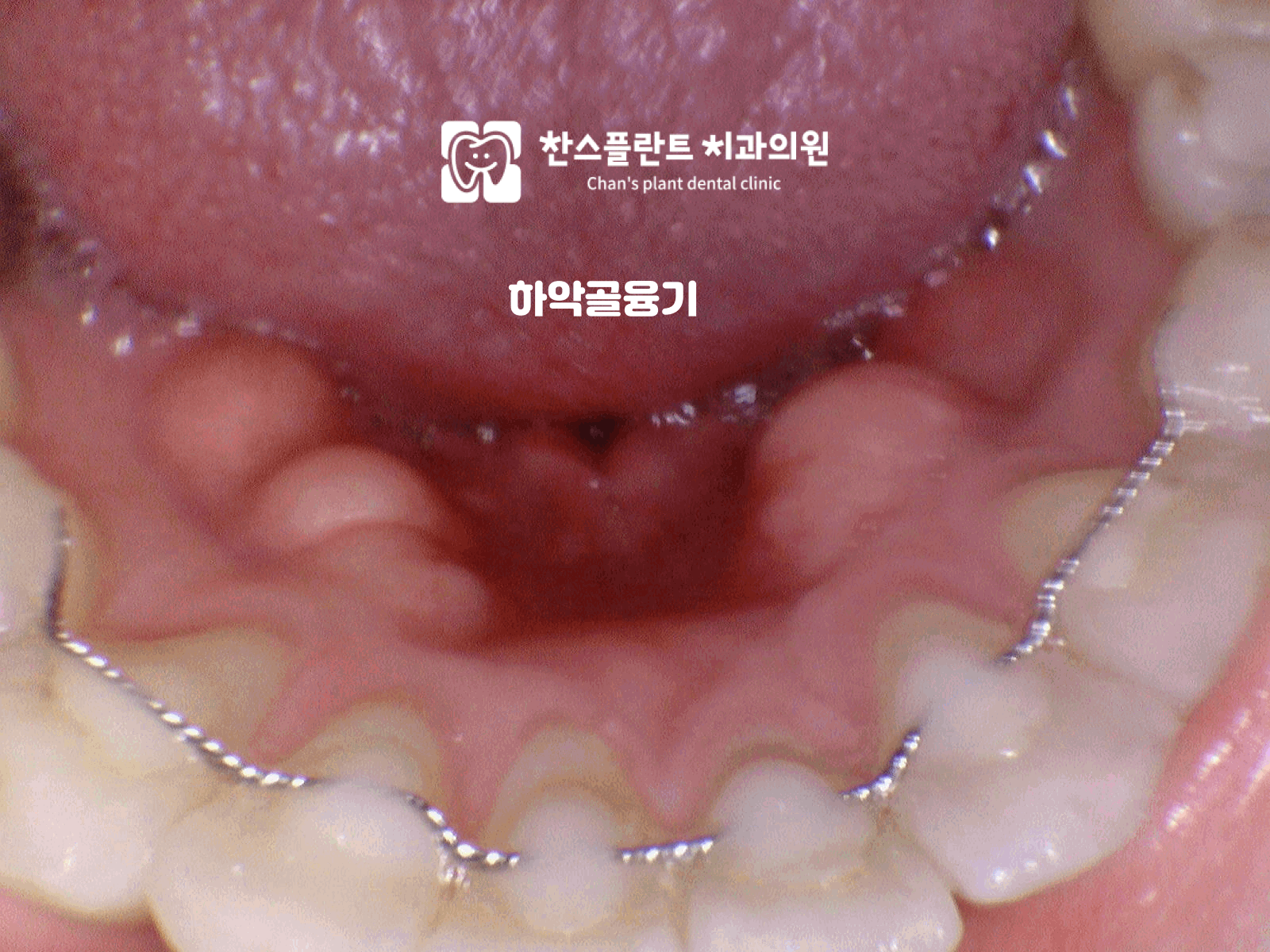 성남 동천역 치과 하악골융기 수술 전 아래턱 안쪽 뼈 돌기