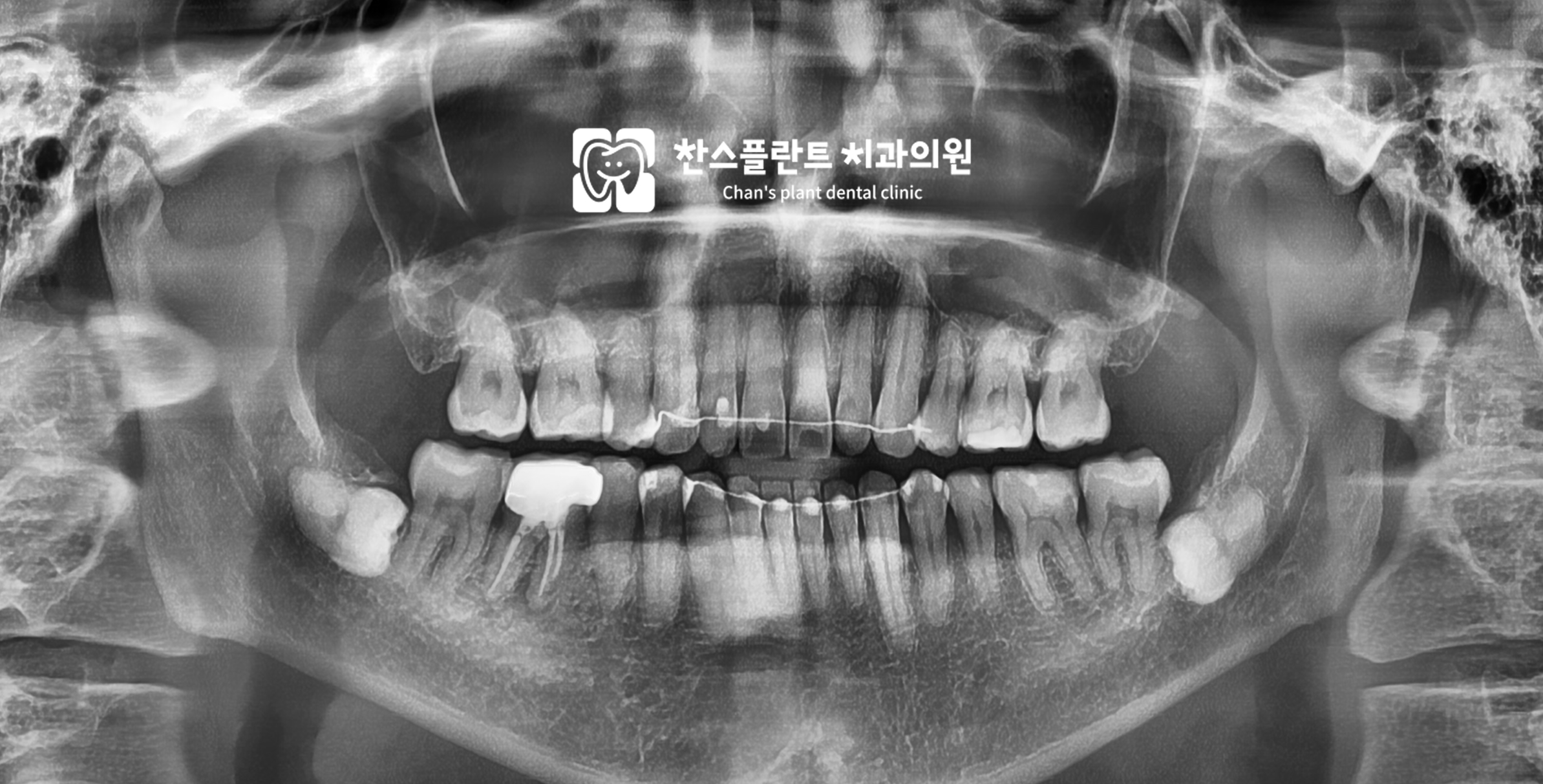 성남 동천역 치과 하악골융기 파노라마 정밀 진단