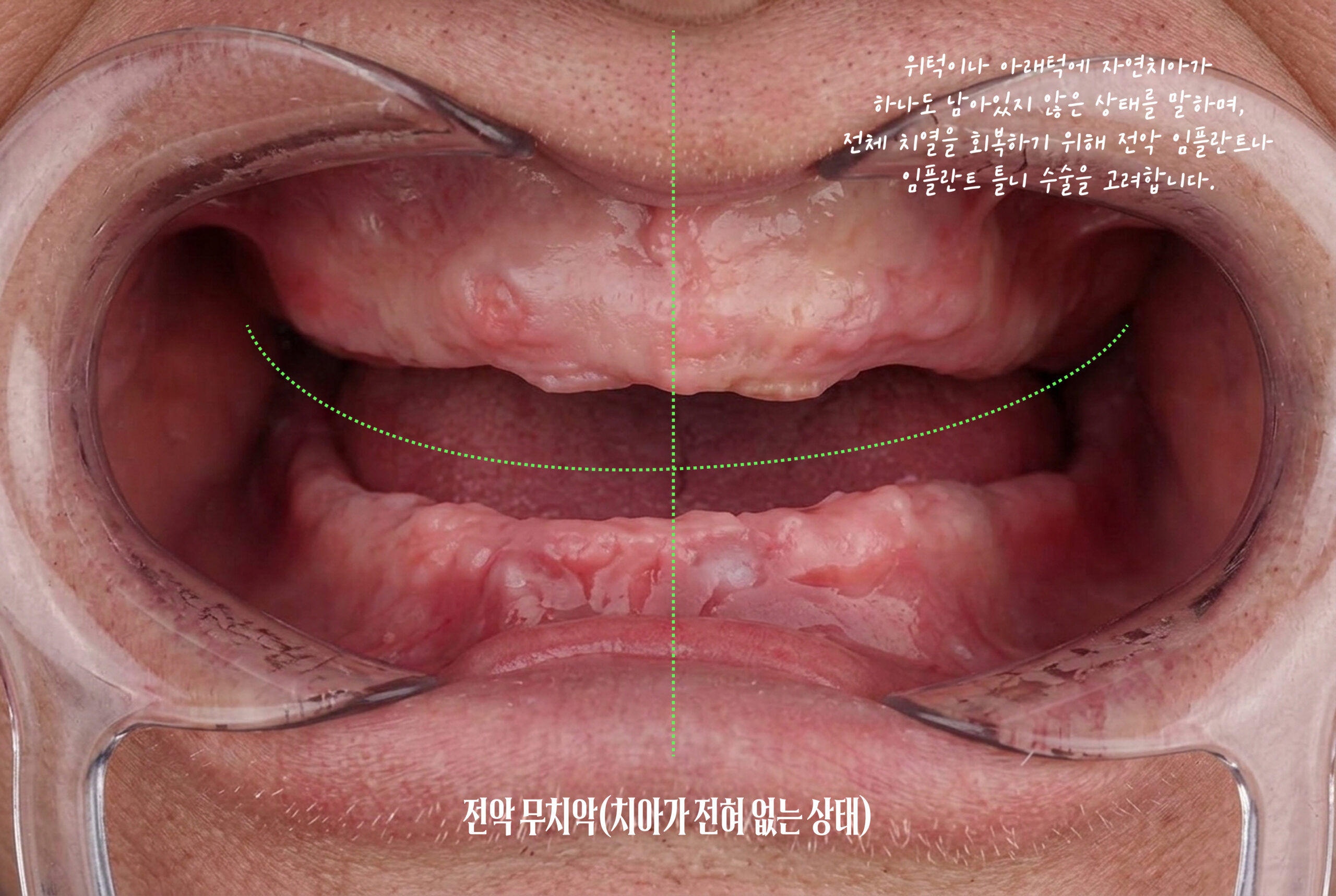 성남 미금역치과 전악무치악 건강보험 임플란트 적용 확대