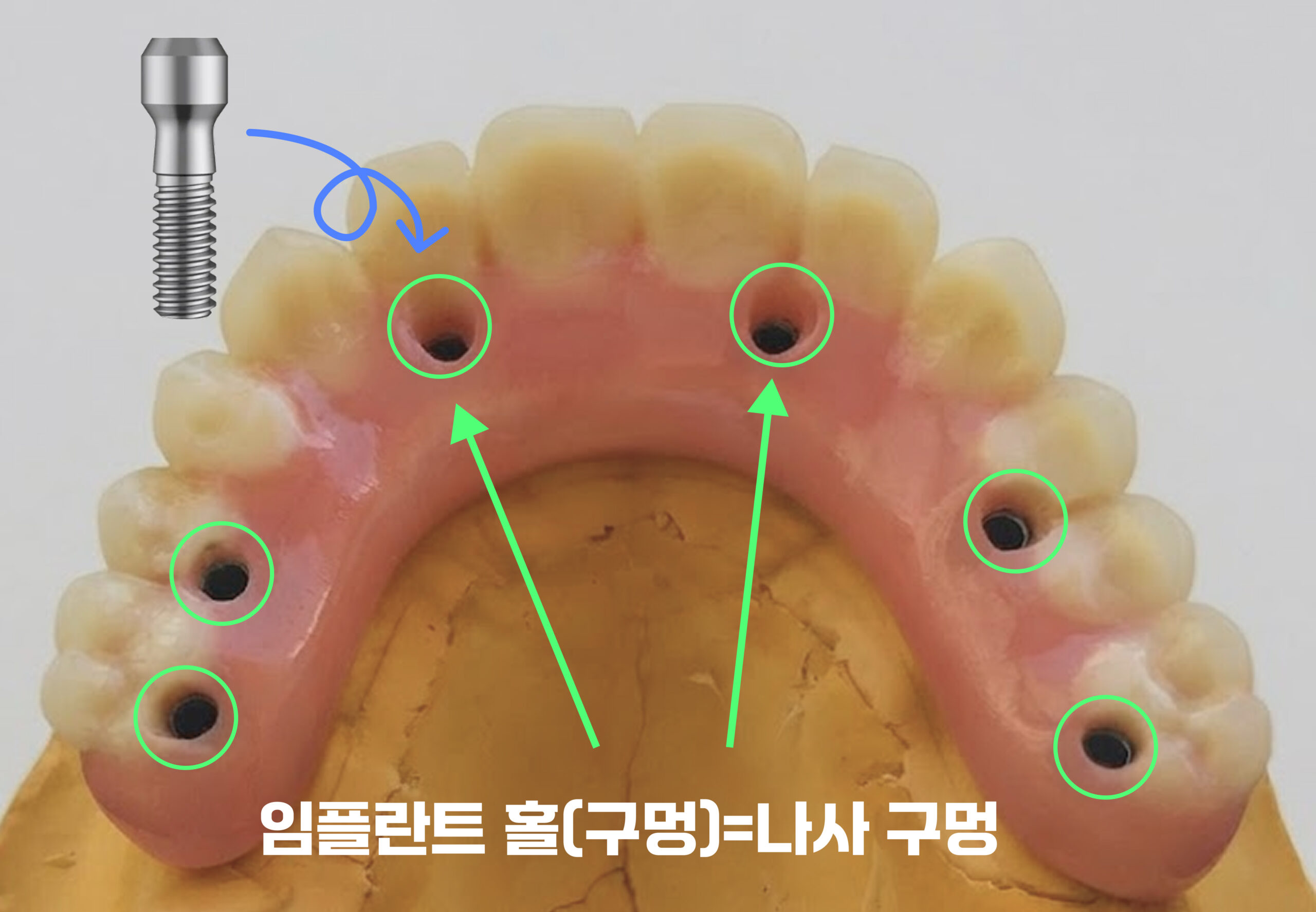 정자역치과 임플란트 홀 역할 나사구멍 올온엑스 보철 설계